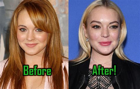 Lindsay Lohan Plastic Surgery Dramatically Changes Her Look