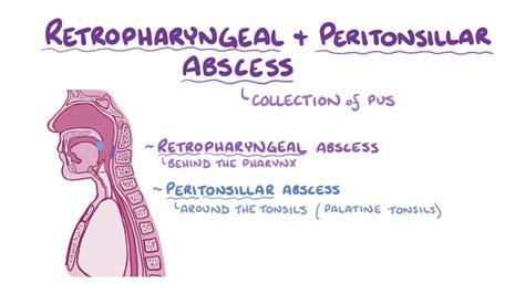 Pathophysiology Of Peritonsillar Abscess