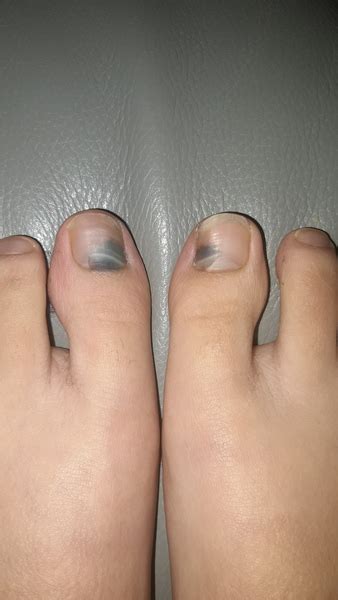 Black Toenails Picture Mumsnet