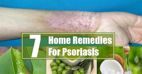 Best 7 Home Remedies For Psoriasis Natural Remedies And Treatment