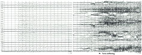 Epilepsy With Isolated Generalized Tonic Clonic Seizures Ictal Eeg [24] Download Scientific