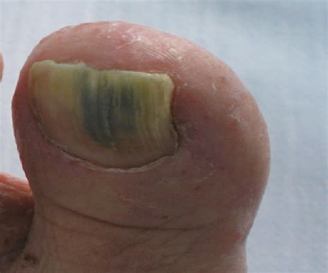 Pdf Chloronychia Green Nail Syndrome Caused By Pseudomonas