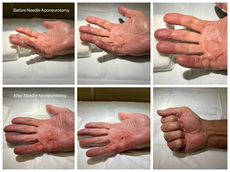 Dupuytrens Contracture Radiation Treatment Wadfordmallegni