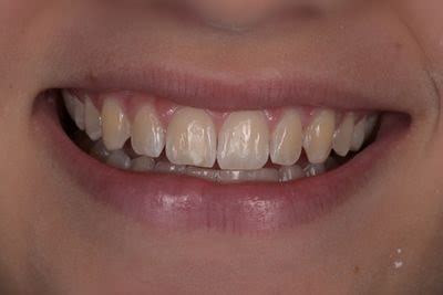 Fluorosi e macchie sui denti Perchè si formano e come risolvere