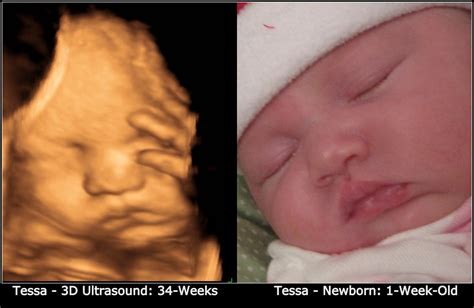 Ultrasound works by listening to the sound waves that are directed from specialized equipment and bounced back, resulting in diagnostic imaging. Mommy Mia Monologues: 3D Ultrasound Photo Side-by-Side ...