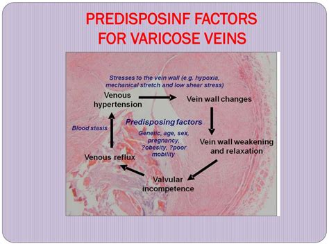 Ppt Varicose Veins Powerpoint Presentation Free Download Id2188360