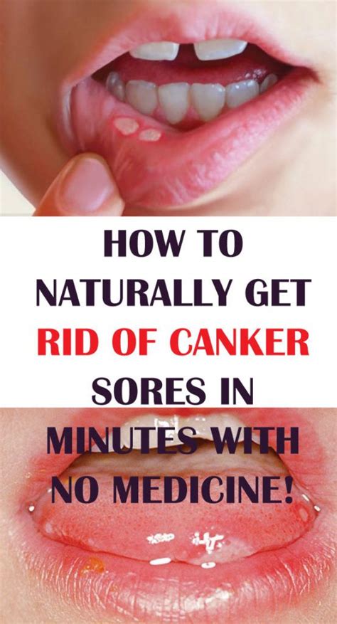 What Is A Canker Sore Have You Ever Had A Sore In Your Mouth That Hurt