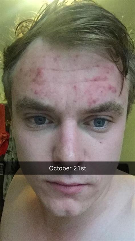 Forehead Acne My 4 Month Battle And Cure 22 Years Old General Acne