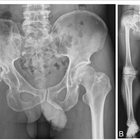 Radiographs Of Both Lower Extremities And The Right Hip After The