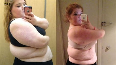 Obese High Babe Babe Who Attempted Suicide Drops Pounds Fox News