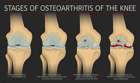 Stages Of Osteoarthritis Of The Knee Stock Illustration Download