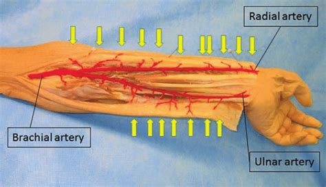 An Anatomical Picture Of The Left Forearm The Brachial Artery Radial