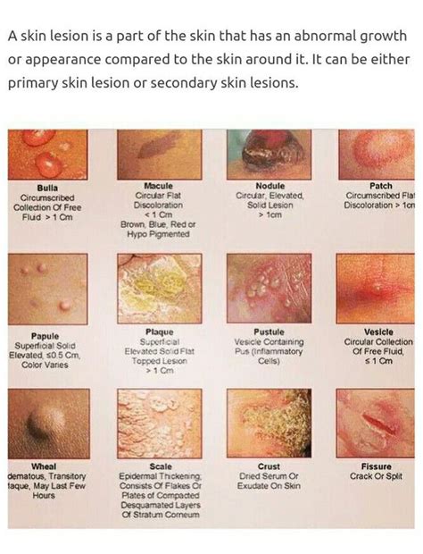 Types Of Skin Lesions Broward Miami Health Institute