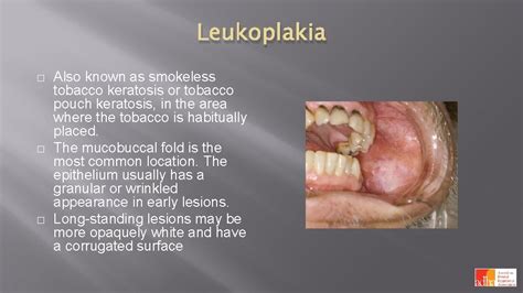 Oral Manifestations Of Tobacco Use Oral Manifestations Tobacco
