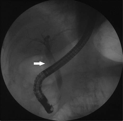 An Ercp Revealed A Dilated Common Bile Duct With A Round Filling Defect