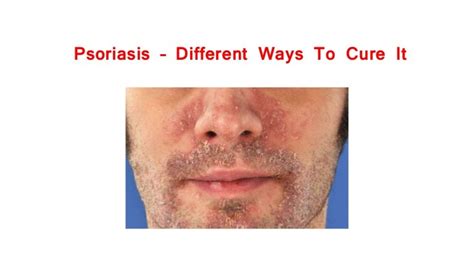 Psoriasis Different Ways To Cure It