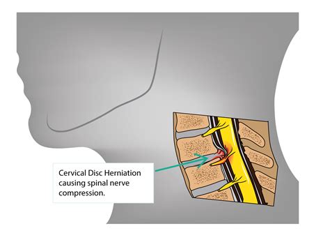 Cervical Disc Herniation And Cervical Radiculopathy Dr Yu Chao Lee
