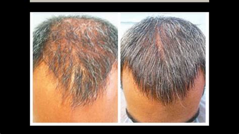 Nizoral Hair Loss Shampoo Treatment And Its Effectiveness