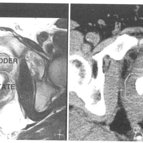 Mri Ct Fusion In Patient B With Previous Abdominoperineal Resection For