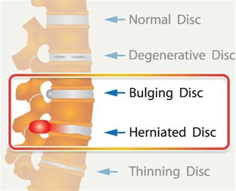 Pain Is A Big Difference Between Bulging Disc And