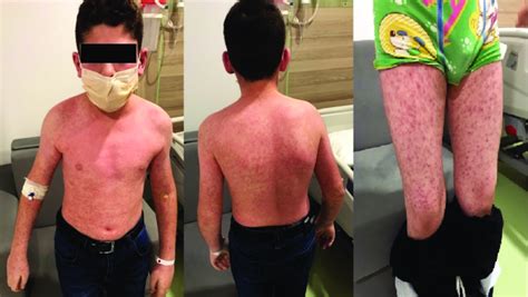 Widespread Maculopapular Rash Observed In The Patient Download