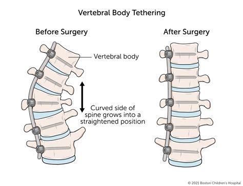 Vertebral Body Tethering Boston Childrens Hospital