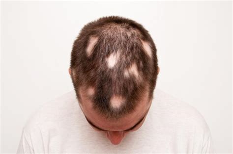 What Is Alopecia Areata What Causes Alopecia Areata Medical News Today