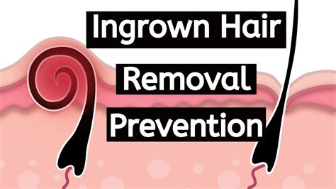 How To Get Rid Of Ingrown Hair How To Prevent Ingrown Hairs How To