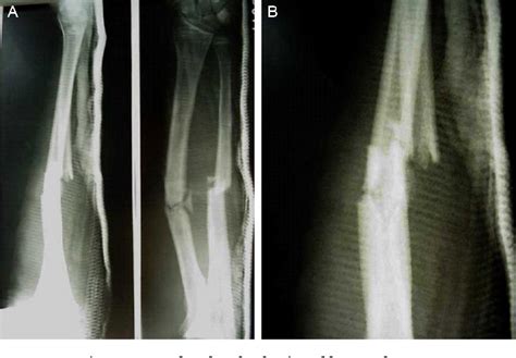 Figure 1 From Ulnar Nerve Paralysis After Forearm Bone Fracture