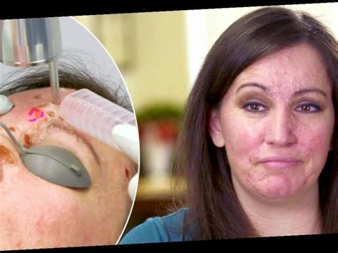 Woman Dubbed Crater Face By Bullies Has 20 Year Old Face Lumps