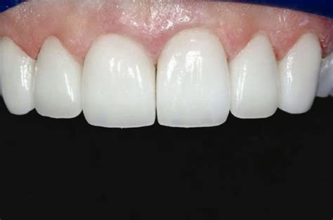 Automix Permanent Dental Cement For Caps Crown Bridges Inlays