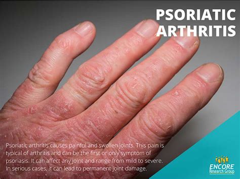 Psoriasis Its More Than Just The Skin Encore Research Group