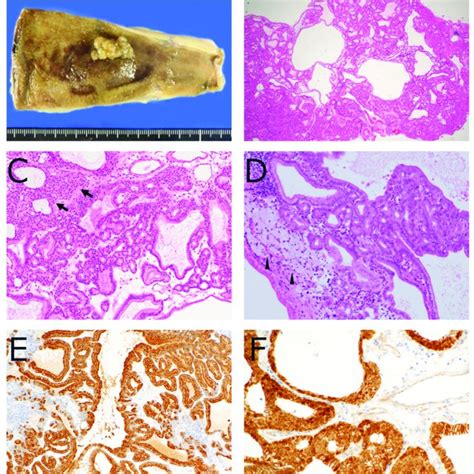 Pathology Of Biliary Intraepithelial Neoplasia Bilin By Hematoxylin
