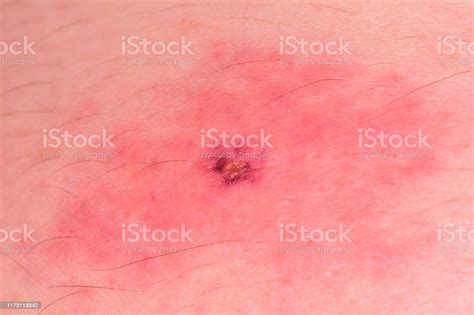 Tick Bite On Irritated Human Skin With Scab Forming Stock Photo