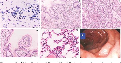 Figure 2 From Eosinophilic Ascites As A Rare Manifestation Of