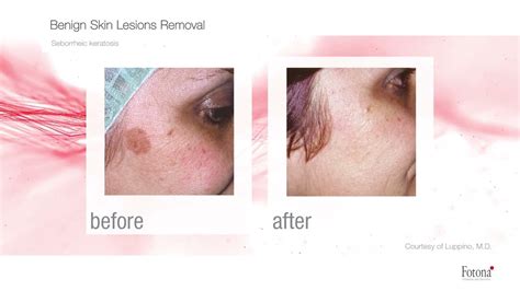 Benign Skin Lesions Removal Youtube