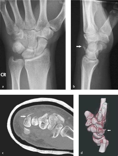 Proximal Row Fractures Other Than Scaphoid And Pisiform