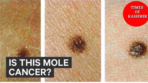 Cancerous Moles How To Get Rid Of Moles On Skin Times Of Kashmir