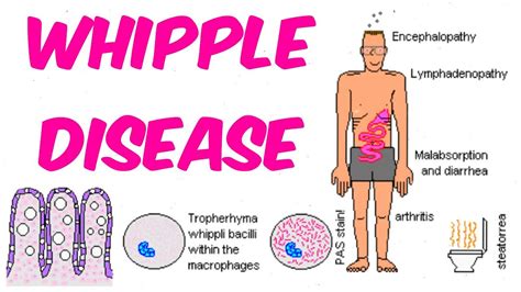 Whipple Disease Causes Symptoms Diagnosistreatment