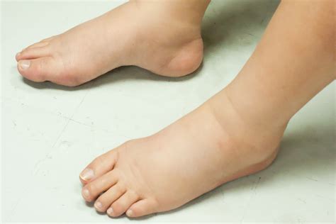 Why Do You Have Swollen Feet And Ankles Wellness Us News