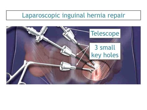 Inguinal Hernia Doctor Clinic Surgery Mumbai Laparoscopic Hernia