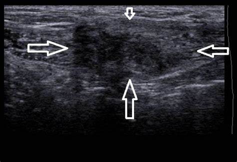 Диета при эндометриозе яичника
