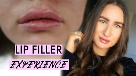 Lip Filler Experience 1ml Juvederm Ultra Youtube