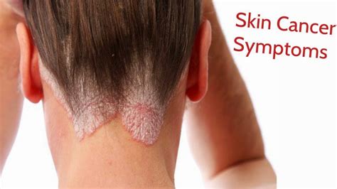 Wellness Lab Health Info Skin Cancer Sign And Symptoms