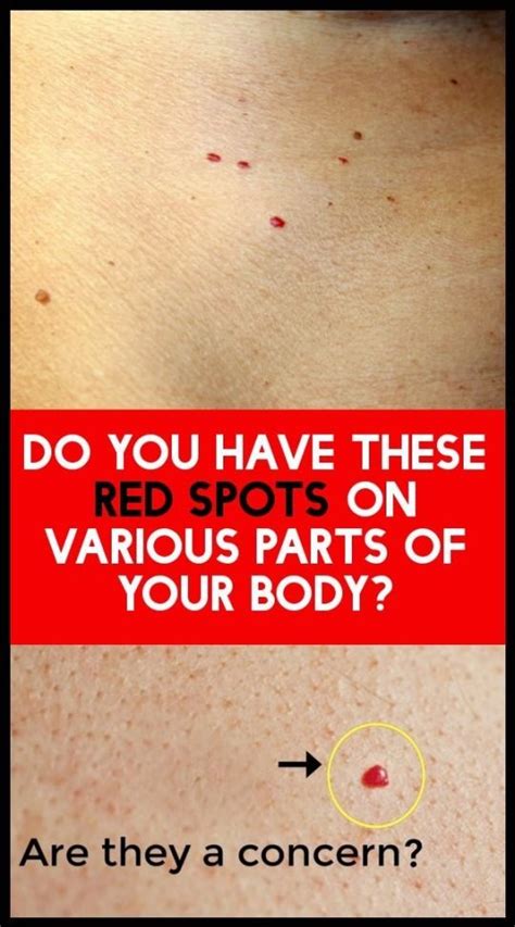 Do You Have These Red Spots On The Different Parts Of Your Body