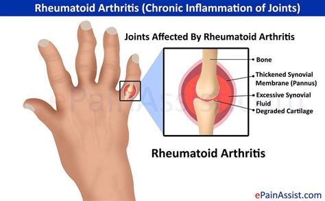 Rheumatoid Arthritis Chronic Inflammation Of Joints