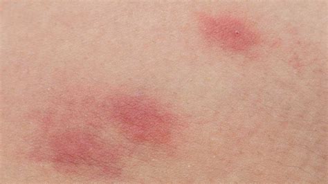 Skin Rash Pictures Causes Types And Treatments