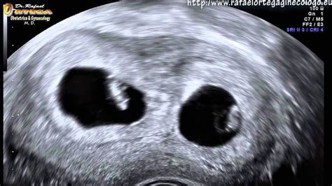 2d Ultrasound 6 Weeks Pregnant Twins Nice Funny Rafael Ortega Muñoz Md