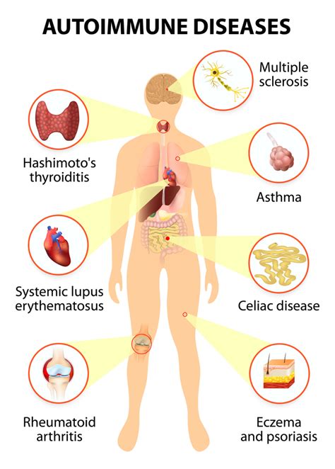 Pure Nature Life Autoimmunity Disorder Testing Central Coast