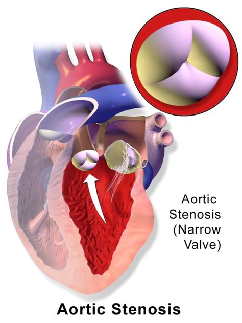 Aortic Valve Disease Patients Can Go For Thv Therapies Now Searcy Law